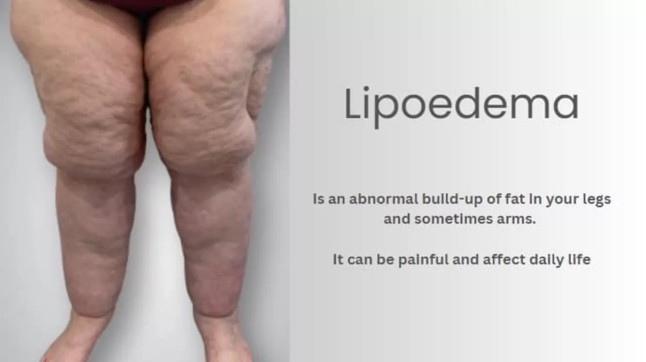 KM Surgical offers treatment for Lipoedema