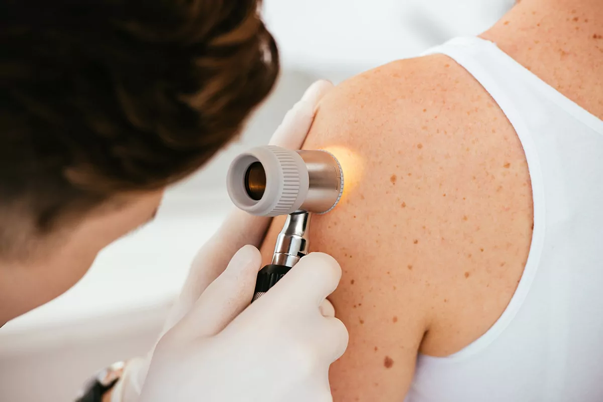 Free Skin Cancer Checks for Over-50s at Canterbury Charity Hospital