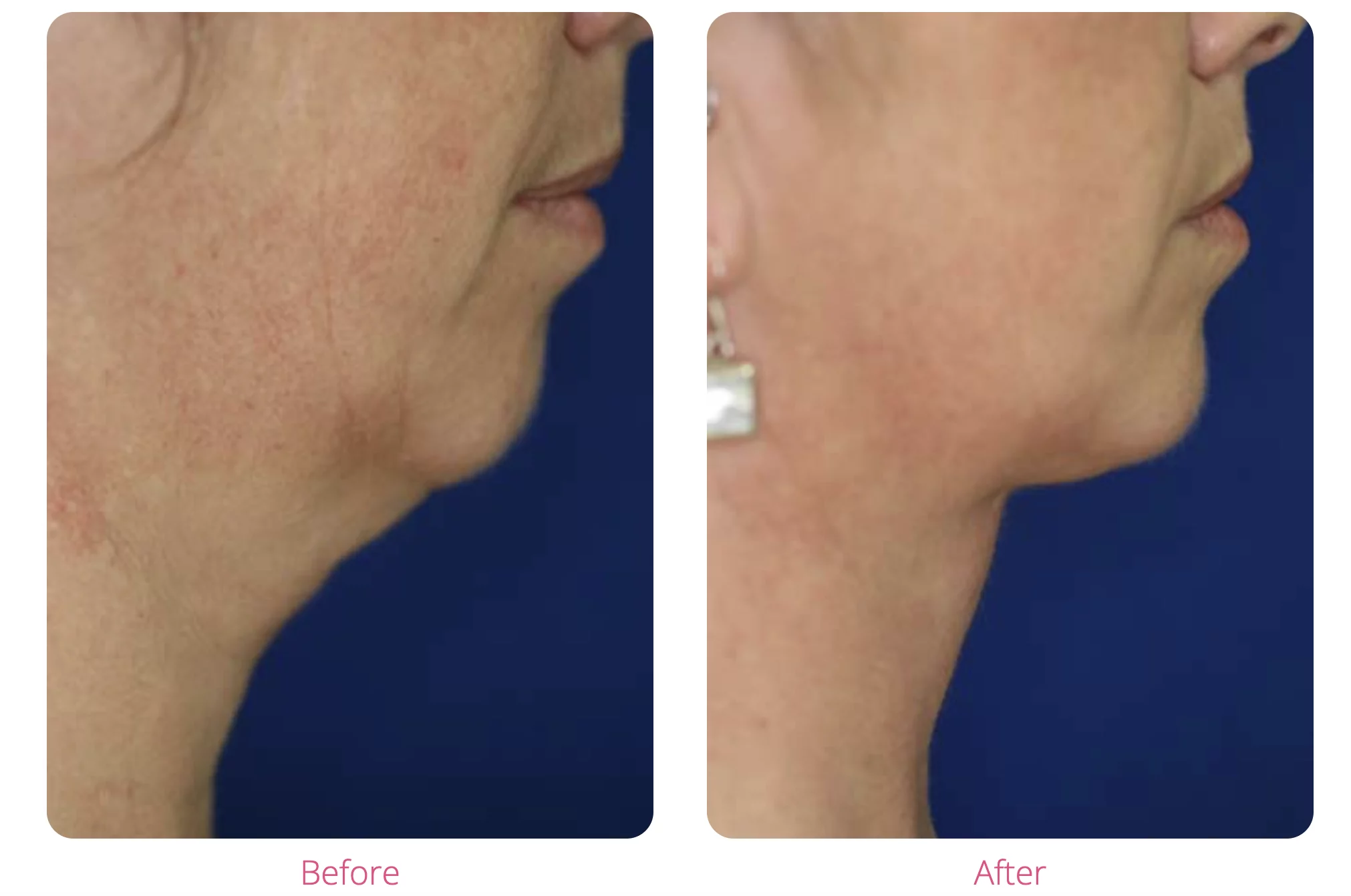 Christchurch Clinic KM Surgical offers liposuction for chin [ad]